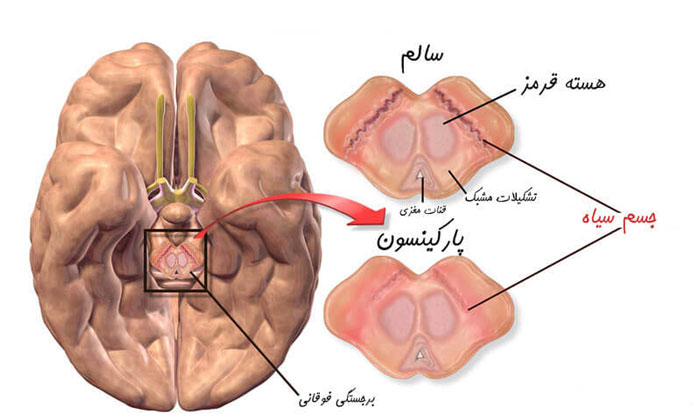 بیماری پارکینسون