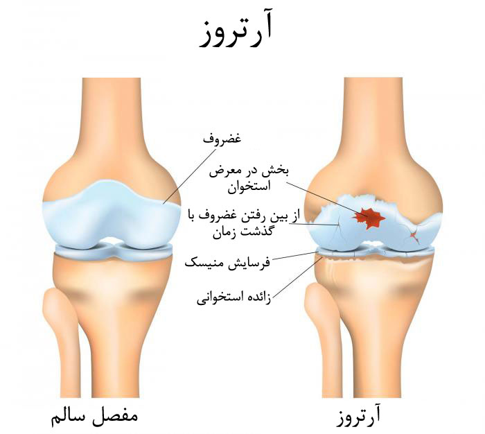 زانوبند اسپیلاوایزر