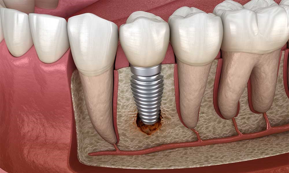 نشانه های خراب شدن ایمپلنت دندان